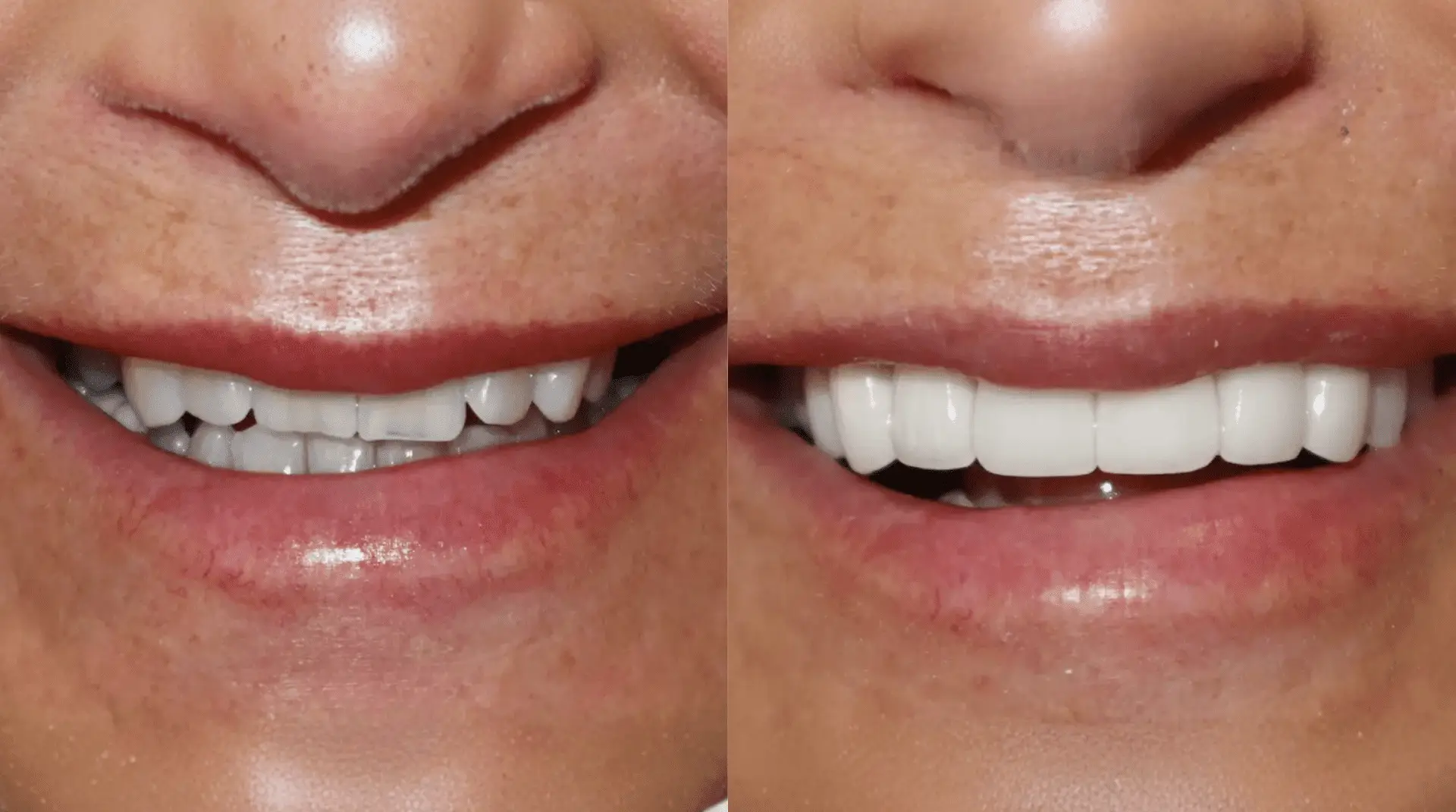 Full smile makeover — 8 porcelain veneers