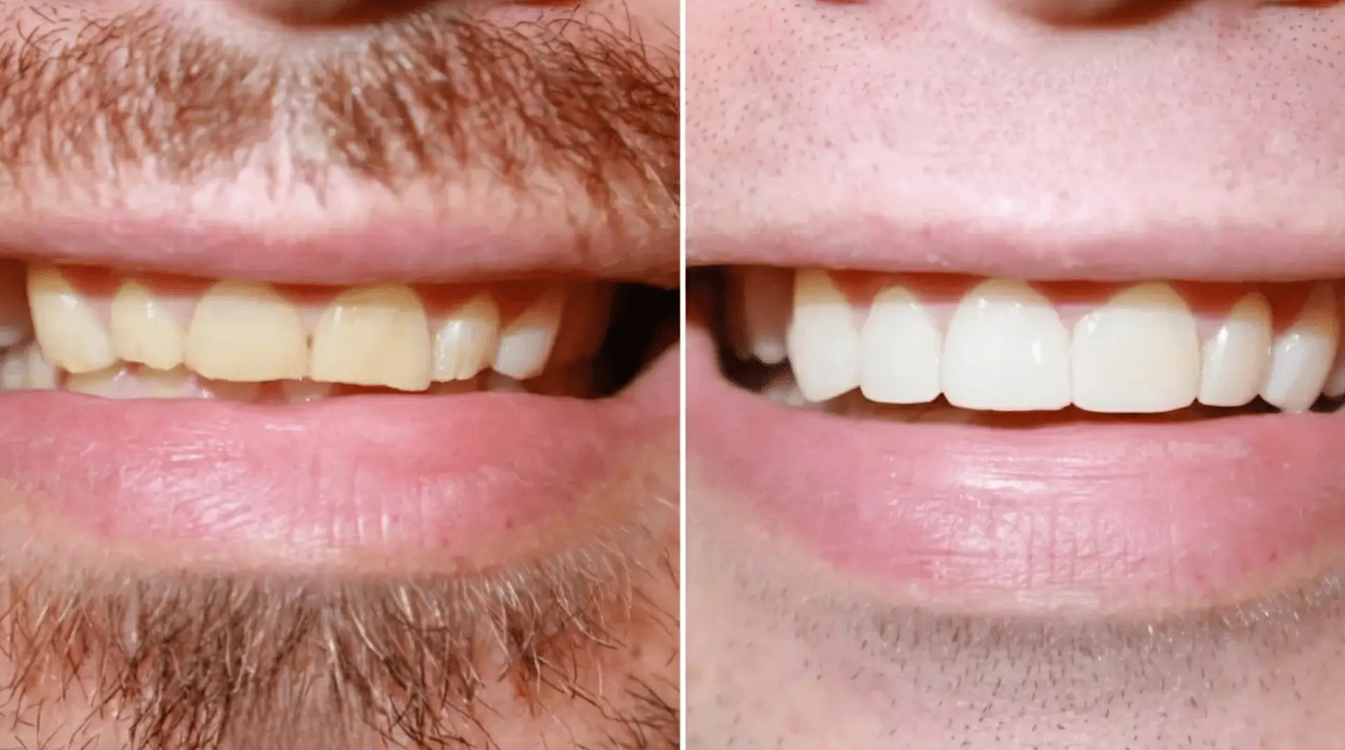 Front teeth transformation — 4 porcelain veneers