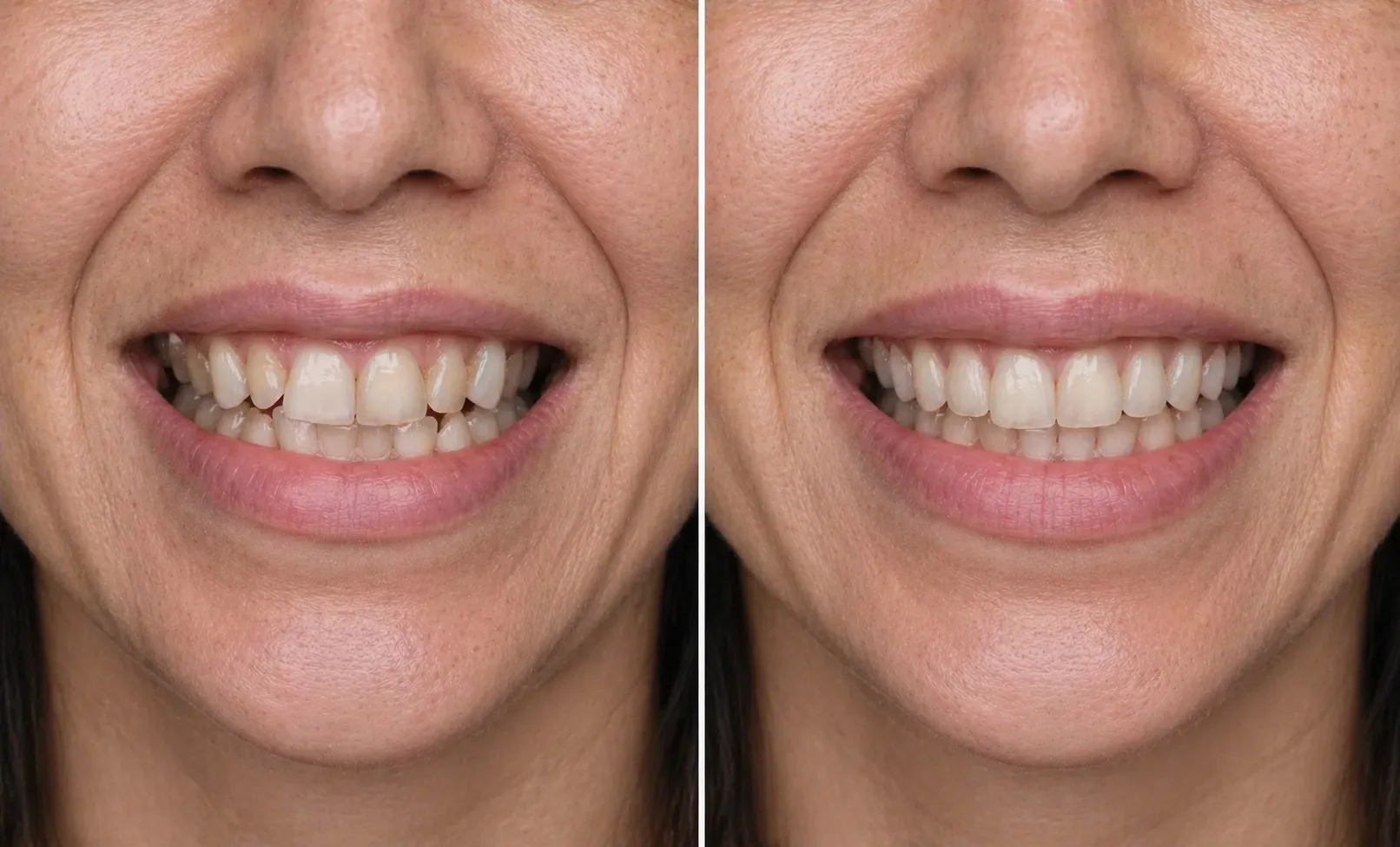 Before and after Invisalign smile transformation