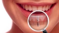 Campbelltown Dental Implants