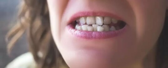 Why crooked teeth are an issue ?