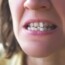 Why crooked teeth are an issue ?